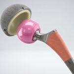 Total Hip Replacement