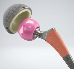 Total Hip Replacement